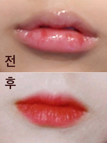 입듈's Filler, Botox review