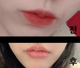 웅와앙's Lip Filler review