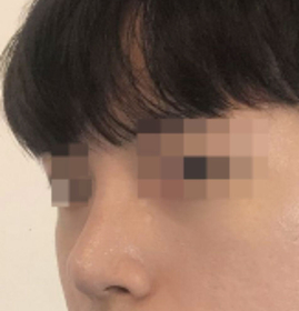 코즈802's Nasal Bridge review