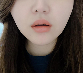 블린이이's Mouth Corner Botox, Lip Filler review