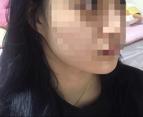 니나낭이잉's Fat-Dissolving Injection, Lifting review