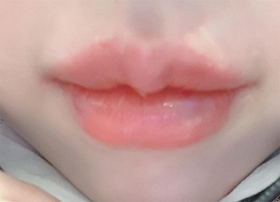 hunnie8894's Lip Filler review