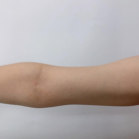 핫썸머썸머's Arm Fat-Dissolving Injection review