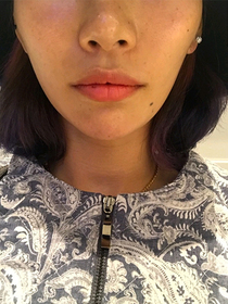 화장하는고양이's Lip Filler, Botox review