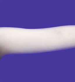 끝이없군's Liposuction review