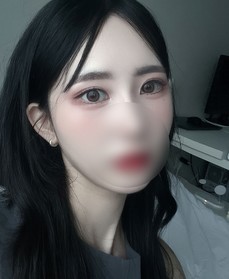 오쪼쪼's Incisional Double Eyelid, Revision review