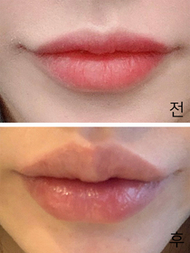 aa11113's Mouth Corners, Lip Filler review