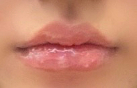 라푼절@'s Lip Filler review