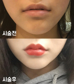 bobommm's Lip Filler review