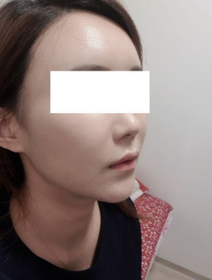 까렁이's Full-Face Fat Grafting review