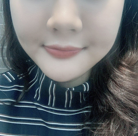 kimy226's Facial Liposuction review