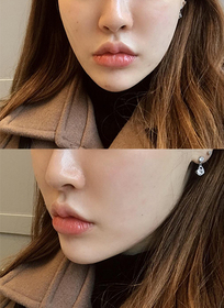 예뻐지구싶다후님의 슈링크, 윤곽톡스 후기