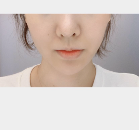 55정이's Thread Lift review
