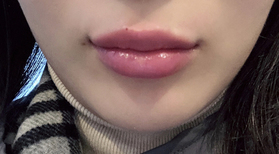 kdykdd's Lip Filler review