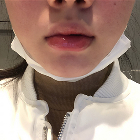 뀨꺙팡이's Lip Filler review
