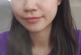 해바라기ssi's Shurink, Contouring Botox review