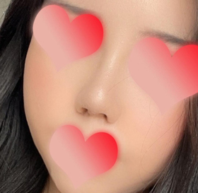 전지현2's Nasal Bridge review