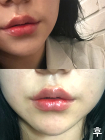 또또루야's Lip Filler, Botox review