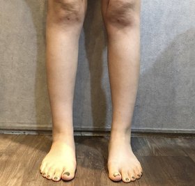 별처럼날아라's Calves, Abdomen, Liposuction review