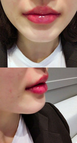 홍홍도도's Lip Filler review