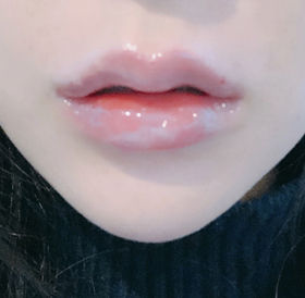 티안나게해줘연's Lip Filler review