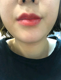 요술곤주's Lip Filler review