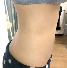별처럼날아라's Abdomen, Calves, Liposuction review
