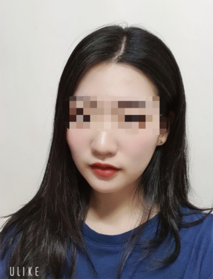 [준회원ngR5DA2]'s Shurink, Botox review