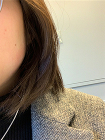 멜랑콜리계절's Jaw Botox review