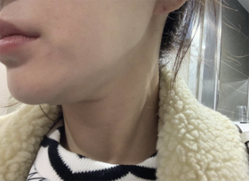 루돌프어뭉's Botox, Contouring Injection review