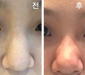 뀨잉3535's Nose Sculpting Injection review