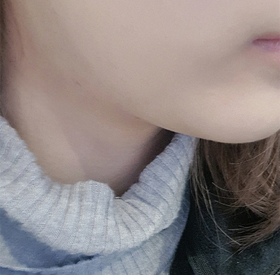 야호양님의 울쎄라리프팅 후기