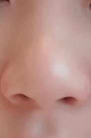 7시11분's Nose Sculpting Injection review
