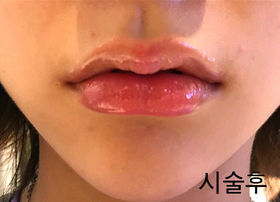 랄랄링동's Lip Filler review