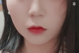 alss12's Facial Liposuction review