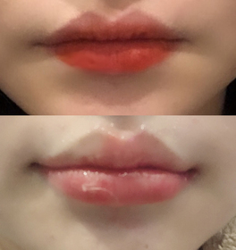 vv림b27's Lip Filler review