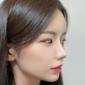 디오르's Nasal Tip, Nasal Bridge, Osteotomy, Dorsal Hump, Deviated Nose review