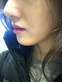 si123's Nose Sculpting Injection review