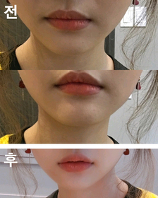 데굴쓰's Lip Filler review