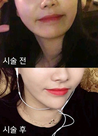 얄라숑쓰's Chin Filler review