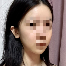 민블리's Facial Contouring review