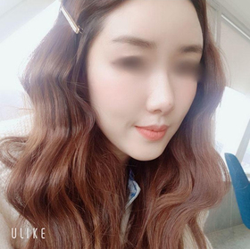 빈빈집's Full-Face Fat Grafting review