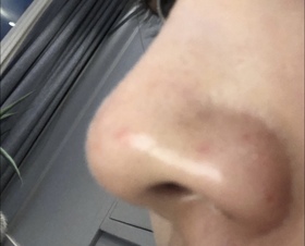 민_디's Nose Sculpting Injection review