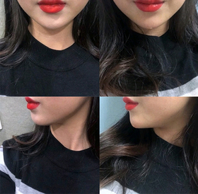 꾬꾱's Chin Filler, Cobblestone Chin Botox review