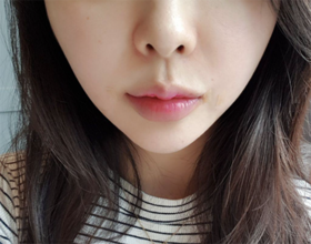 똥꾸빵꿍's Thread Lift review