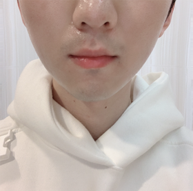 왕밤빵단팥빵님의 슈링크, 윤곽주사 후기