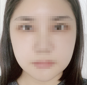 오잉잉아's Facial Contouring, Nose, Fat Grafting review