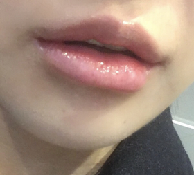 여여여여12's Lip Filler review