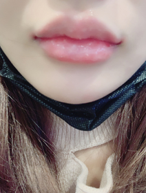 여어엉엉's Lip Filler review