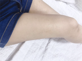 zz0808's Liposuction review